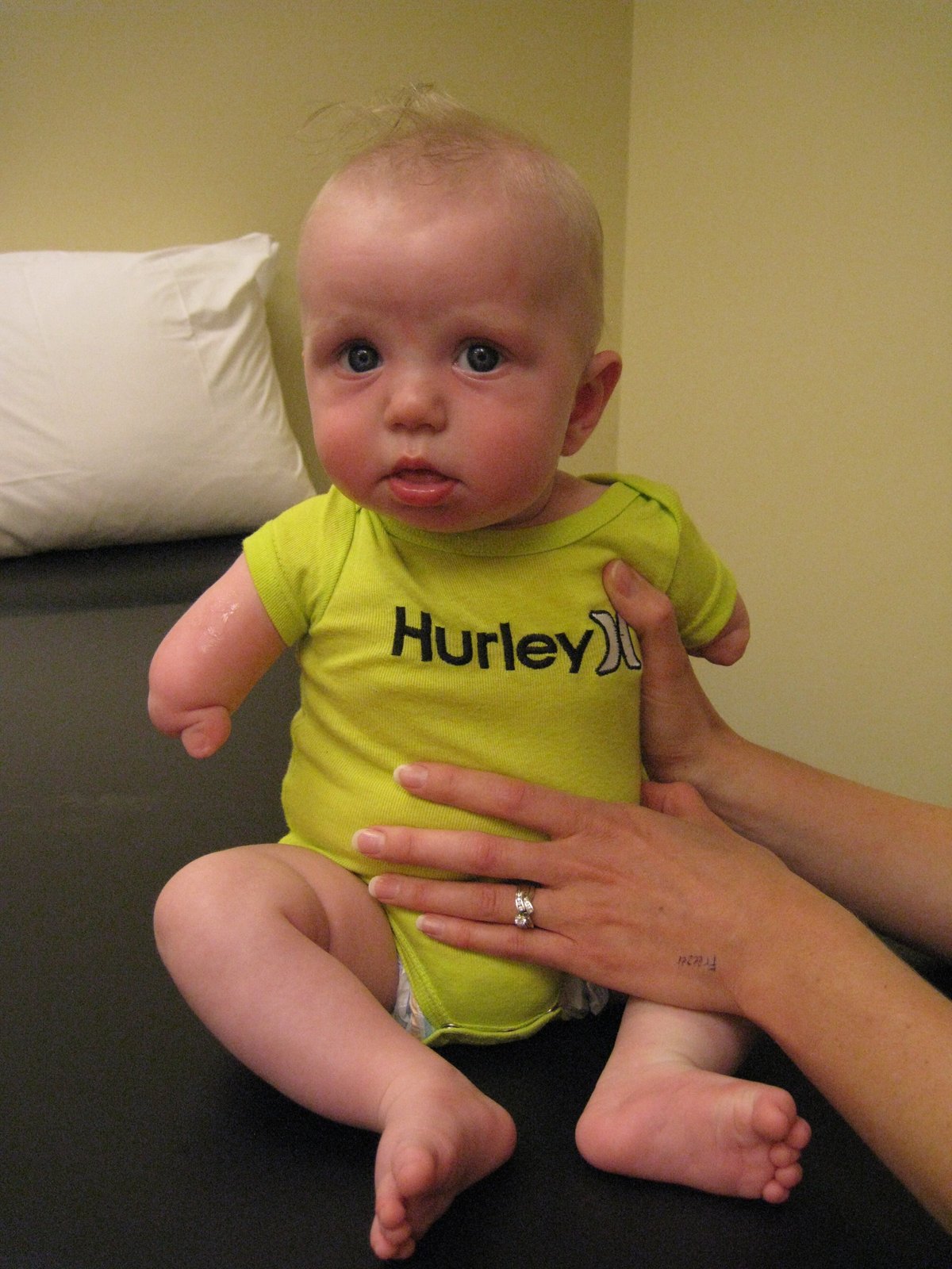 Setting Him Up for Success Jameson’s Experience with a Congenital